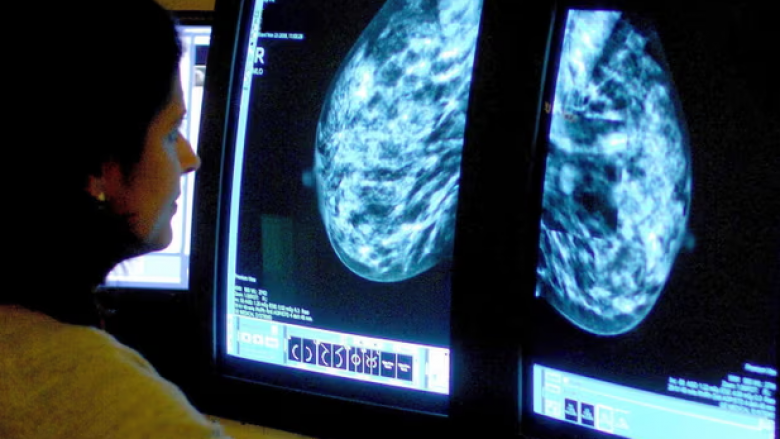 Mjekët zhvillojnë mjetin me Al i cili parashikon efektet anësore te pacientët me kancer gjiri