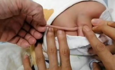 Foshnja lind me bisht prej dhjetë centimetrave – çfarë thonë mjekët rreth këtij fenomeni në Kinë