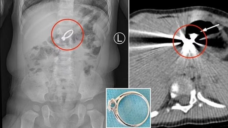 Kinezja 15-muajshe gëlltiti unazën e ëmës me gurë diamanti – detyrohet t’i nënshtrohet ndërhyrjes kirurgjikale për t’ia larguar  