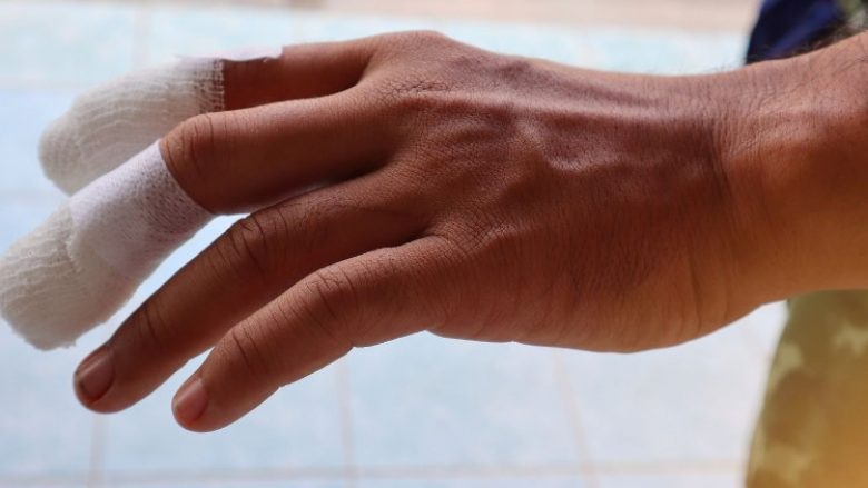 I kërkoi mjekut t’ia heqë dy gishta të dorës pasi besonte se nuk ishin të tij – kanadezit i realizohet ëndrra pasi plotësoi disa kushte
