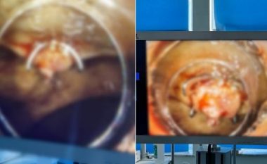 Rasti i dytë i ndërprerjes së gjakderdhjes masive nga stomaku, procedura Ovesco Klip kryhet në Klinikën e Gastroenterologjisë