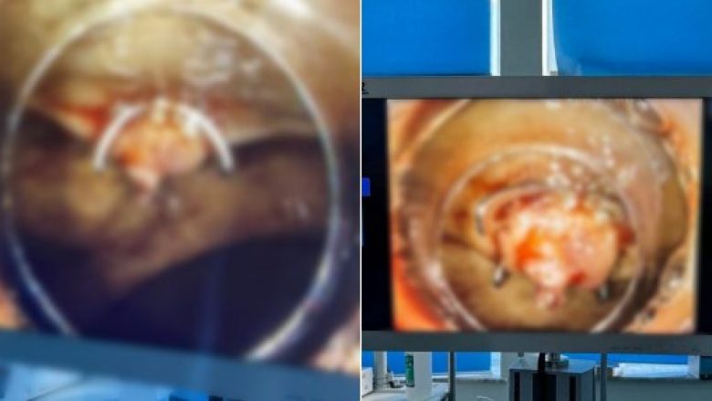 Rasti i dytë i ndërprerjes së gjakderdhjes masive nga stomaku, procedura Ovesco Klip kryhet në Klinikën e Gastroenterologjisë
