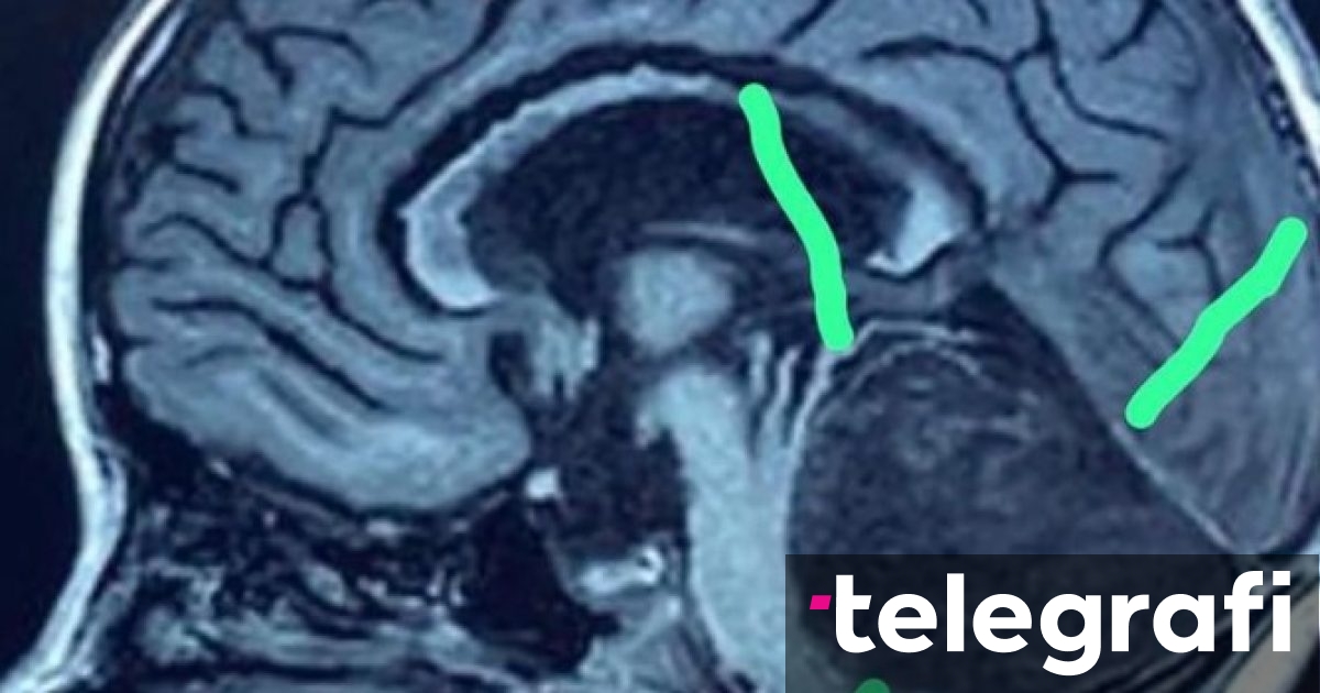 Një rreze X zbuloi një  masë të pazakontë  në trurin e një vajze  Mjekët nuk mund ta besonin atë që po shihnin  operohet urgjentisht tetëvjeçarja
