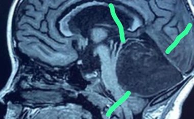 Një rreze X zbuloi një “masë të pazakontë” në trurin e një vajze: Mjekët nuk mund ta besonin atë që po shihnin, tetëvjeçarja u operua urgjentisht