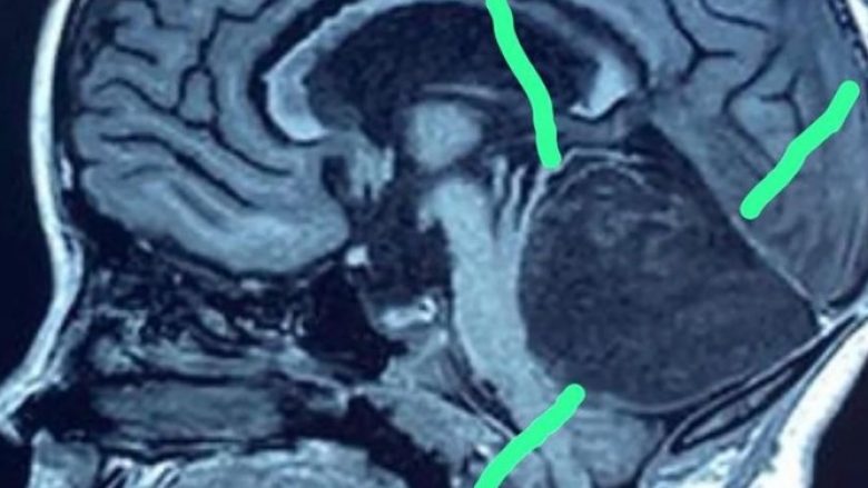Një rreze X zbuloi një “masë të pazakontë” në trurin e një vajze: Mjekët nuk mund ta besonin atë që po shihnin, operohet urgjentisht tetëvjeçarja