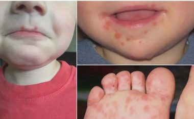 Sëmundja “duar-këmbë-gojë”, mjekët: Kujdes, po prek fëmijët në çerdhe e kopshte