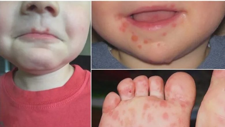 Sëmundja “duar-këmbë-gojë”, mjekët: Kujdes, po prek fëmijët në çerdhe e kopshte
