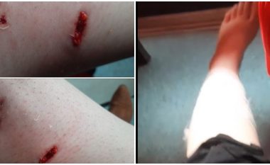 Gazetarja e RTK-së sulmohet nga qentë endacakë në Prishtinë