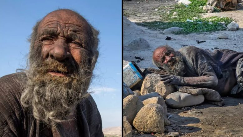 Historia e trishtueshme e njeriut që nuk është pastruar për 60 vjet - mjekja tregon se pse ai e shmangu ujin e sapunin