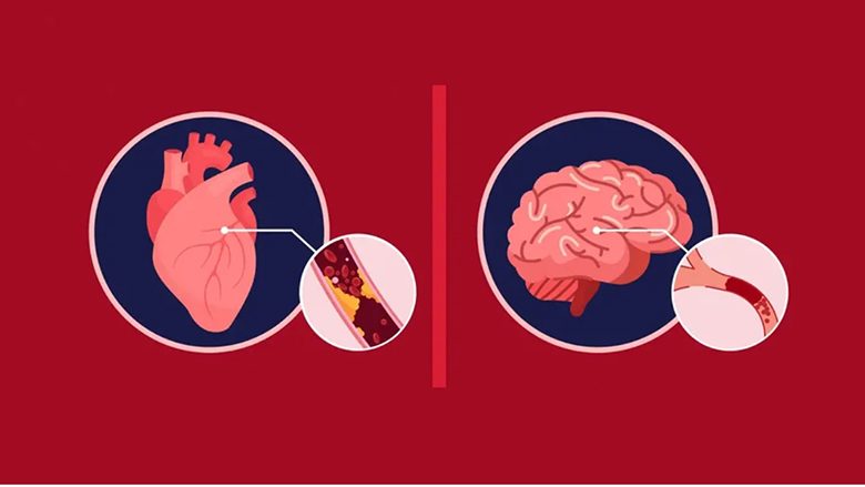 Dallimi mes sulmit në zemër dhe sulmit në tru – shenjat që nuk duhet t’i injoroni kurrë