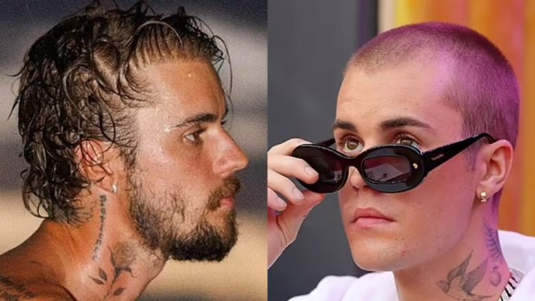 A është kjo provë që Justin Bieber kishte një transplant flokësh? – Kirurgu i famshëm zbulon shenjat e habitshme