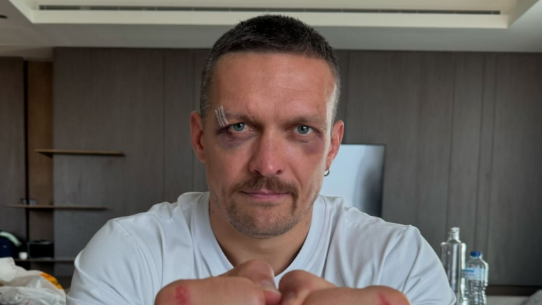 Oleksandr Usyk shfaq lëndimet që ka pësuar në duar nga grushtimi i Tyson Furyt