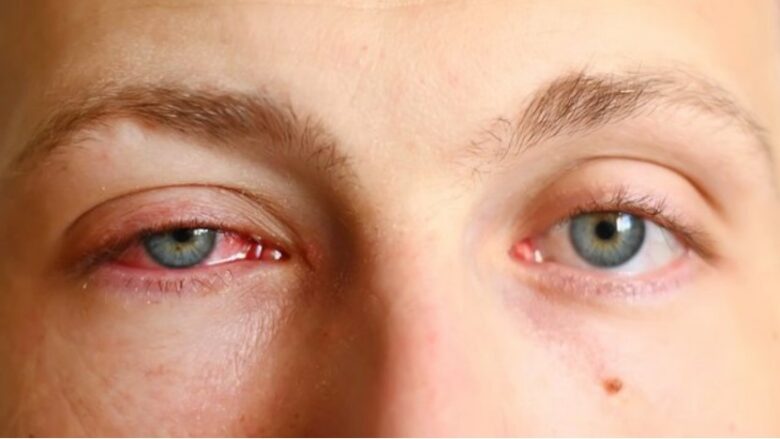 Virozat dhe gripi i syrit: Sëmundjet virale po prekin të gjitha moshat, shoqërohet me temperaturë