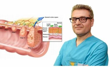 Intervistë me Doc. Dr. Andrej Nikolovski: Shfaqja e gjakut në jashtëqitje, kapsllëku, jashtëqitja e lëngshme, dhimbje barku në formë prerjeje, fryrja e barkut janë simptoma të kancerit të zorrës së trashë