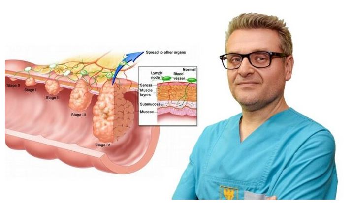 Intervistë me Doc. Dr. Andrej Nikolovski: Shfaqja e gjakut në jashtëqitje, kapsllëku, jashtëqitja e lëngshme, dhimbje barku në formë prerjeje, fryrja e barkut janë simptoma të kancerit të zorrës së trashë