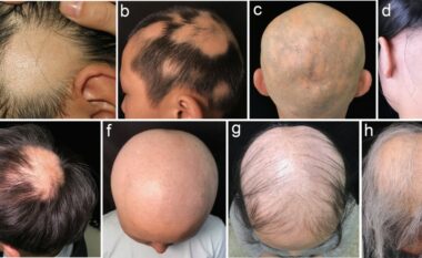 Është miratuar nga FDA një medikament për trajtimin e alopecisë areata të rëndë te të rriturit