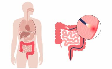 Çfarë është kolonoskopia dhe kur duhet bërë?