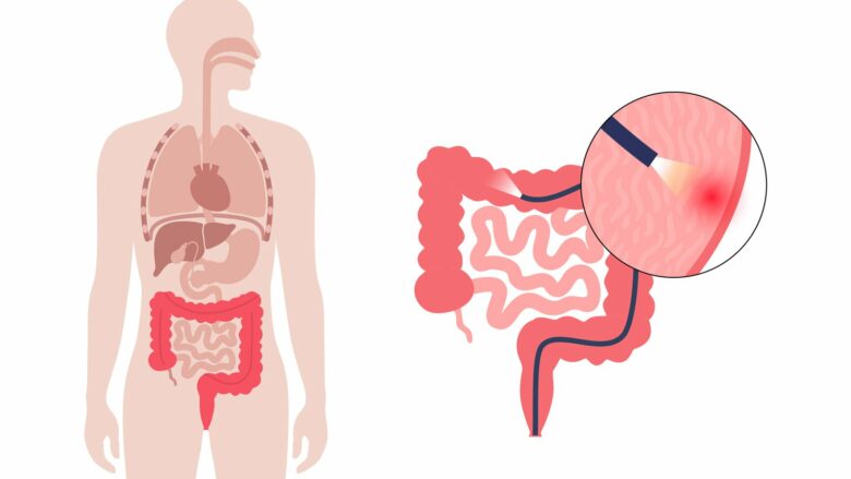 Çfarë është kolonoskopia dhe kur duhet bërë?