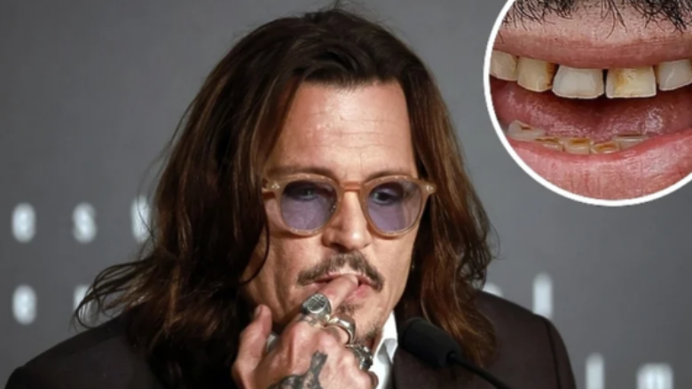 Më në fund: Johnny Depp rregullon dhëmbët