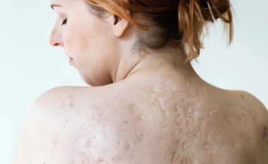 Çfarë është Hidradenitis suppurativa – një sëmundje kronike e lëkurës që ndikon keq në cilësinë e jetës së pacientëve?