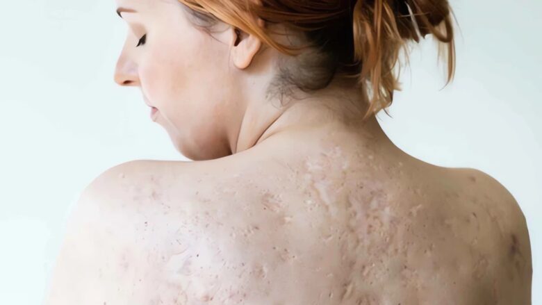 Çfarë është Hidradenitis suppurativa – një sëmundje kronike e lëkurës që ndikon keq në cilësinë e jetës së pacientëve?